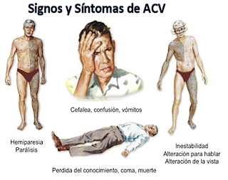 ¿Qué pruebas de laboratorio nos ayudan a saber si tenemos riesgo de sufrir un ictus?